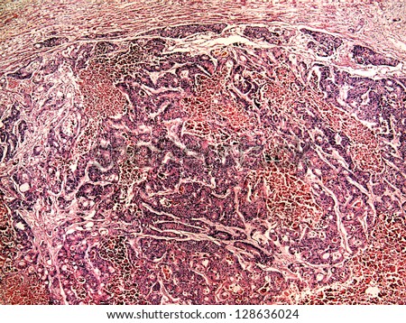 Liver cancer of a human, photomicrograph panorama as seen under the microscope, 50x zoom.