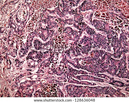 Liver cancer of a human, photomicrograph panorama as seen under the microscope, 100x zoom.