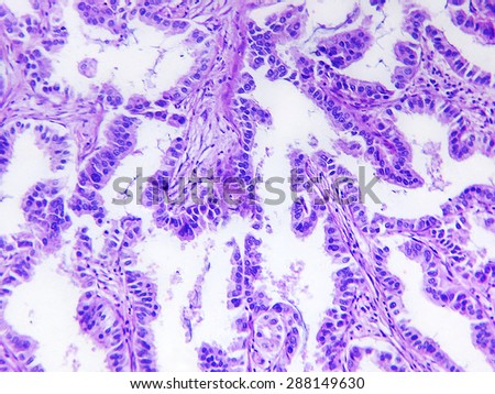Well differentiated adenocarcinoma of a human, photomicrograph panorama as seen under the microscope, 200x zoom.