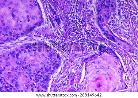 Squamous cell carcinoma of a human, photomicrograph panorama as seen under the microscope, 200x zoom.
