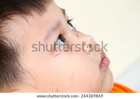 Close up of The bruising under the young boy eyes