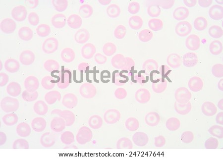 Codocytes, abnormal red blood cells with a bullseye appearance in haematology.
