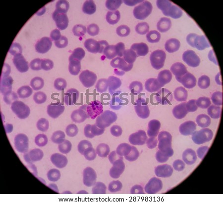 Malaria. Normal and infected red blood cells. Malaria is a disease caused by a parasite called Plasmodium that is spread to humans by the bite of an infected mosquito