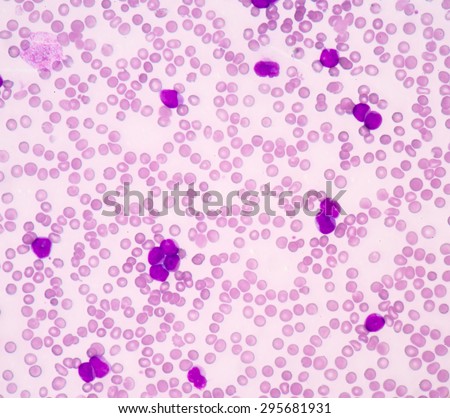Blood smear  show acute myeloblastic leukemia(AML).The smear shows large number of cancer leukemia cells (large blue cells) with the smaller red to pink normal red blood cells or erythrocytes.