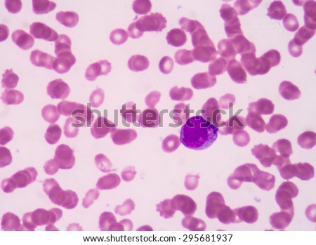 A blood smear is often used as a follow-up test to abnormal results on a complete blood count (CBC) to evaluate the different types of blood cells.Promyelocyte.