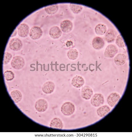 Bacteria and white blood cells in urine specimen under microscope 400x.
