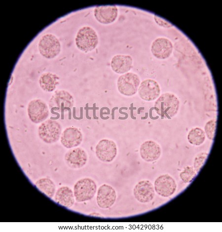 Bacteria and white blood cells in urine specimen under microscope 400x.