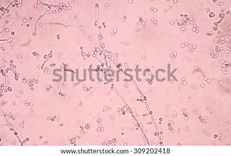 budding yeast cells with pseudohyphae in urine sample fine with microscope.