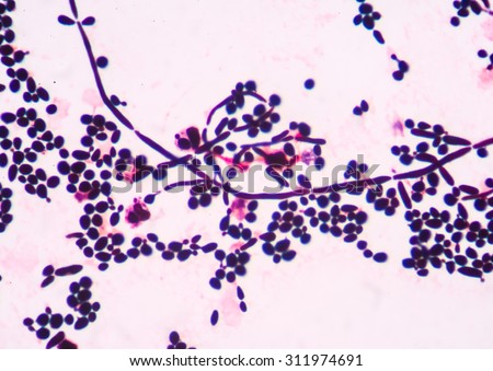 Branching budding yeast cells with pseudohyphae in urine gram stain fine with microscope.
