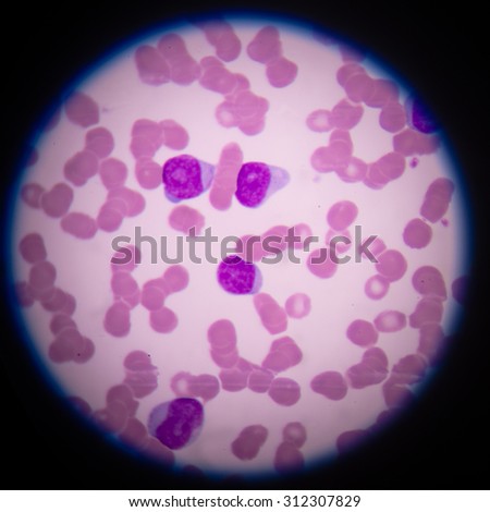 What Causes Nucleated Red Blood Cells In Adults What Causes Nucleated Red Blood Cells In Adults
