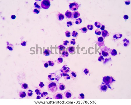 White blood cells in peritoneal fluid. unfocused