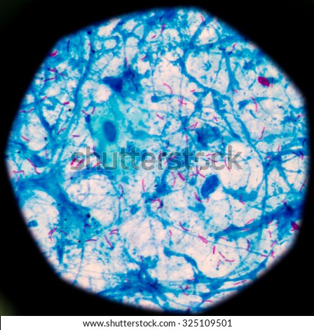 Bacterial infection tuberculosis.red cells in blue background.AFB 3+