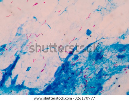 Bacterial infection tuberculosis.red cells in blue background.AFB 3+ fine with microscope.