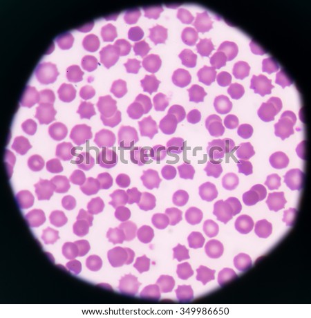 Abnormal red blod cells star shape medical background.