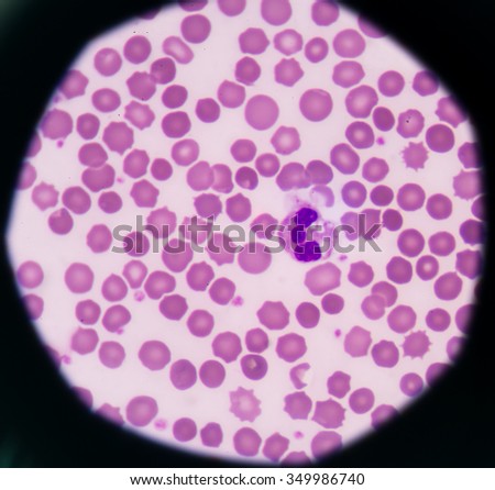 Neutrophil abnormal cell medical science background.