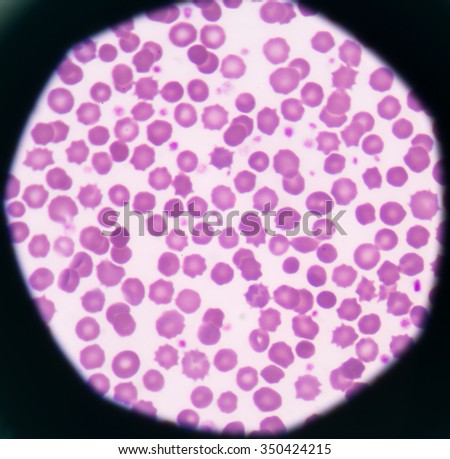 Abnormal red blod cells star shape medical background.