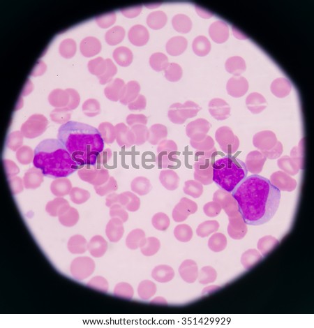 blood smear is often used as a follow-up test to abnormal results on a complete blood count (CBC) to evaluate the different types of blood cells.Medical science background showing blast cells(AML)