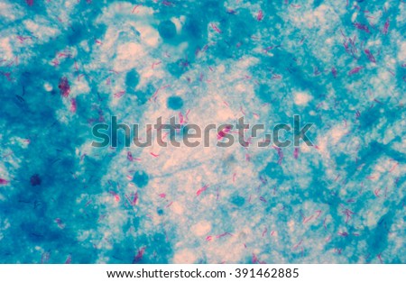 Micro bacterium tuberculosis 3+ moderate red cells on blue background .Medical science background concept.