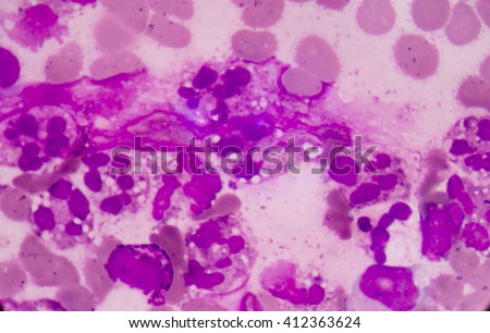Abnormal neutrophil in pleural fluid smear.Sepsis or septicaemia is a life-threatening illness. Presence of numerous bacteria in the blood, causes the body to respond in organ dysfunction.