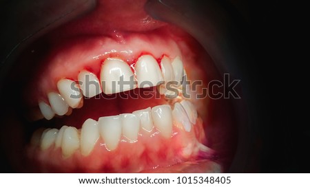 Mouth with bleeding gums on a dark background. Close up.