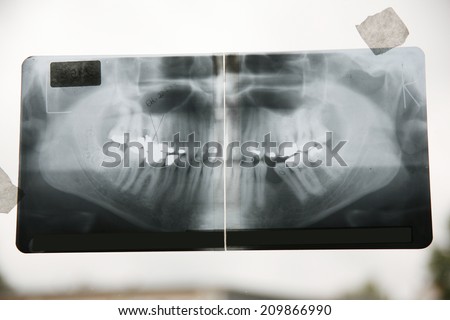 tooth X-ray full-image