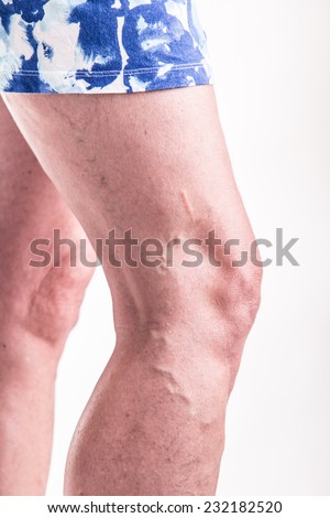 Varicose Veins on the legs of woman - studio shoot