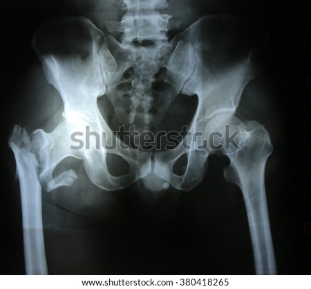 X-rays images in good quality / Fracture bone