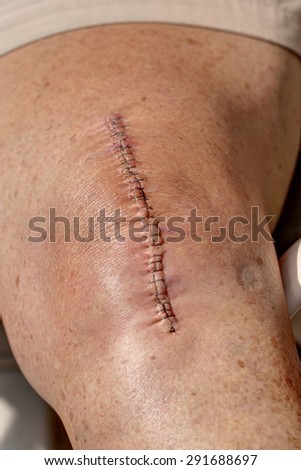 Knee surgery staple wound on leg of recovering woman