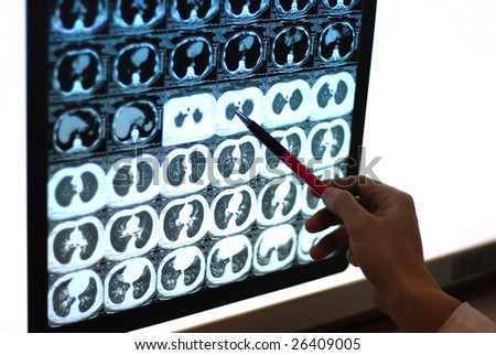 pen showing X-ray pictures of lung