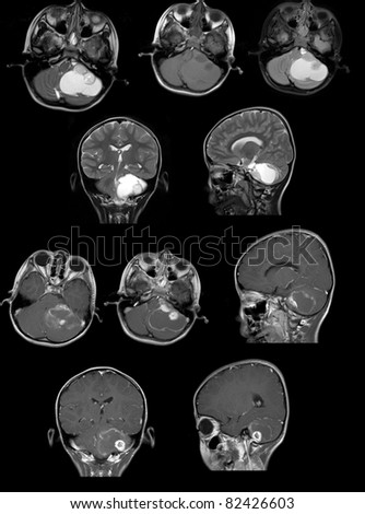 Mri Tumour