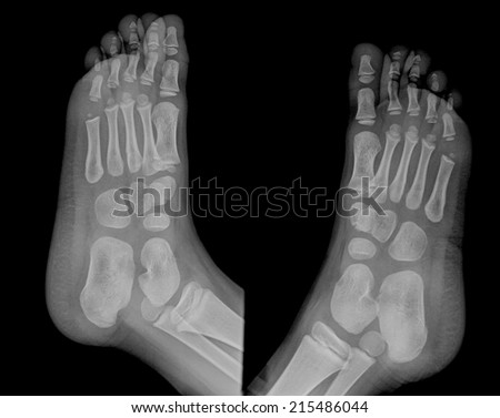 film x-ray foot AP LT & RT : show normal child\'s foot