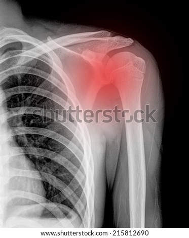 X-ray of pain shoulder joint ( Clavicle Antero-posterior ) on black blackground