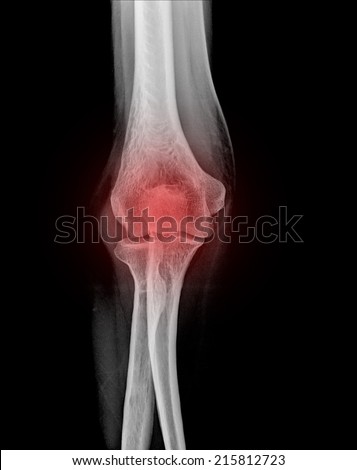 pain elbow x-rays ( Elbow joint Antero-posterior )on a black background