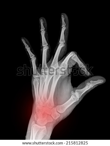 x-ray pain hand ( Hand Lateral ) on black background
