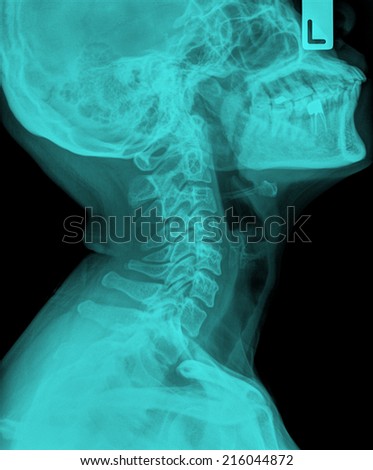 x-ray of neck with marking L ( Cervical Spine Lateral )