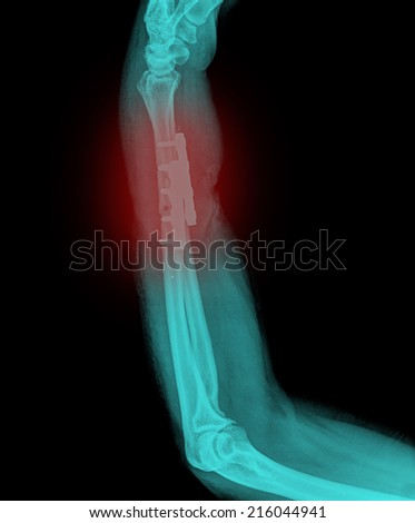 x-ray arm with plate screw ( Forearm Antero-posterior )