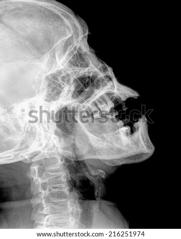 x-ray of neck when mouth open  ( Cervical Spine Lateral )