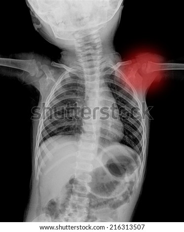 Chest x-ray film of children ( chest postero-anterior )