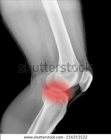X-rays of leg fracture patients ( Knee joint Lateral )