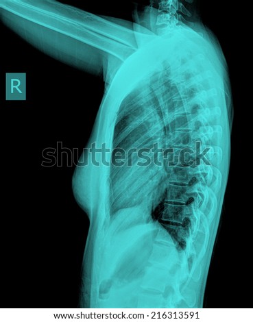 film X-ray women Upper thoracic spine Lateral skull