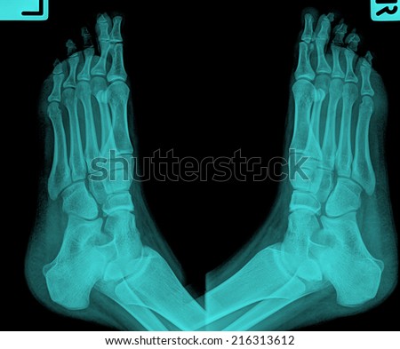 x-ray of foot ( Foot Antero-posterior )