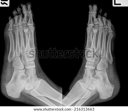 x-ray of foot ( Foot Antero-posterior )