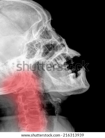 x-ray of neck ( Cervical Spine Lateral )