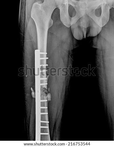 broken human thigh x-rays image with implant ( plate and screw )