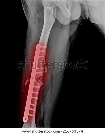 broken human thigh x-rays image ,Right leg fracture