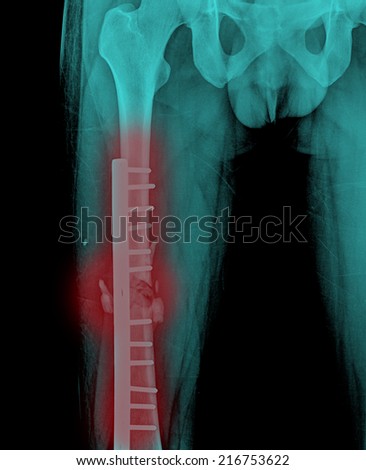 broken human thigh x-rays image with implant ( plate and screw )