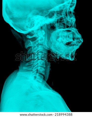 x-ray of the cervical spine (CR)