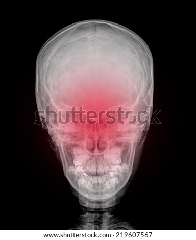 x-ray image of the painful or injury skull , head injury