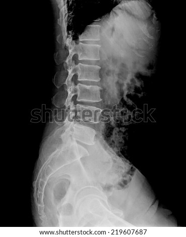 Scanning of a right lateral lumbar spine radiograph taken, among others radiographs, to try to detect the origin of pain in the hip of an adult man