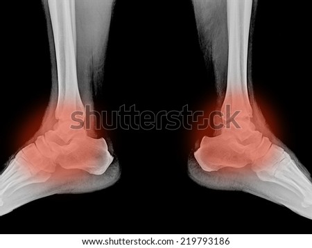 foot and ankle pain on x-ray, isolated on black background